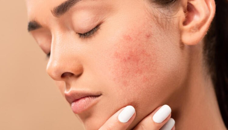 تهيج البشرة