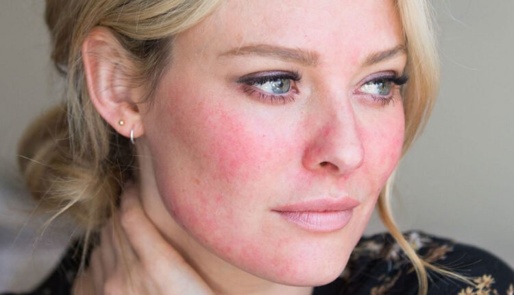 احمرار الوجه