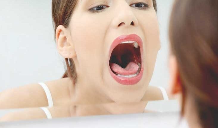 تورم اللسان