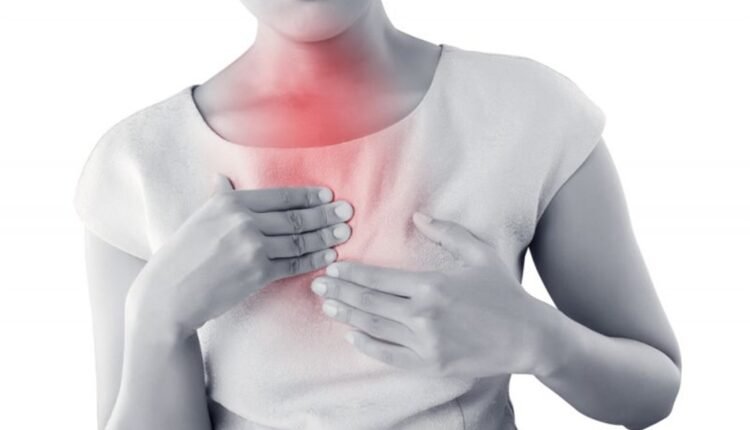 حرقة المعدة