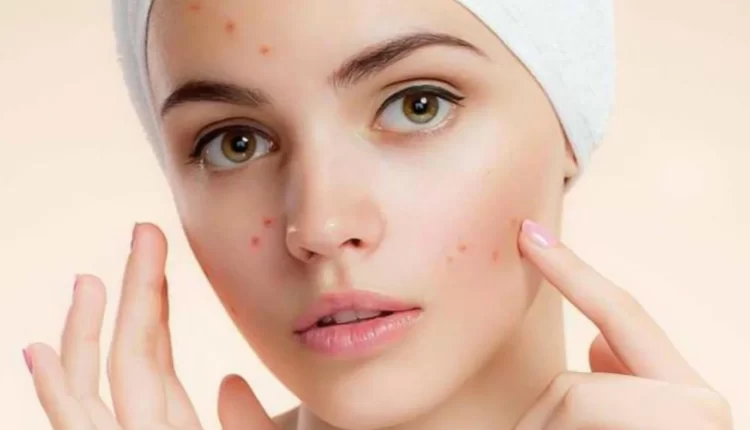 البشرة الدهنية