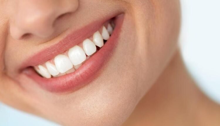 تبييض الأسنان