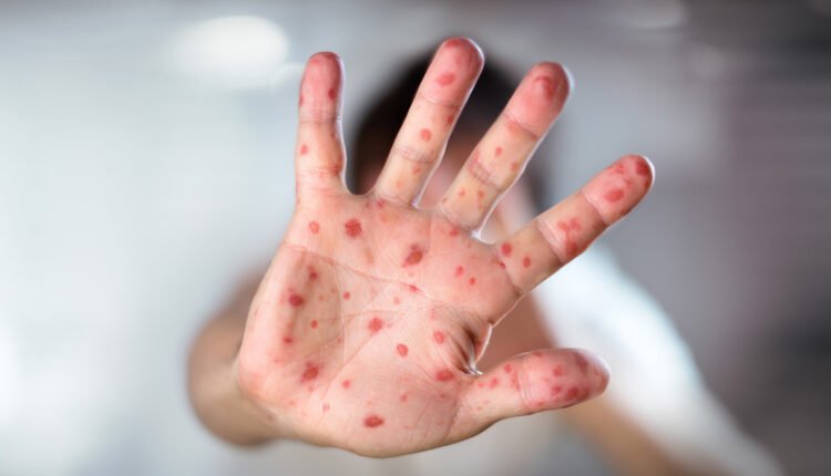 جدري القردة